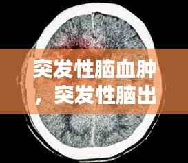 突发性脑血肿,突发性脑出血有什么症状